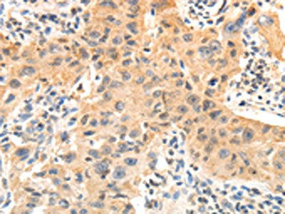 The image on the left is immunohistochemistry of paraffin-embedded Human lung cancer tissue using OCLN Antibody(OCLN Antibody) at dilution 1/10, on the right is treated with fusion protein. (Original magnification: x200)Rabbit anti-Human OCLN Polyclonal Antibody