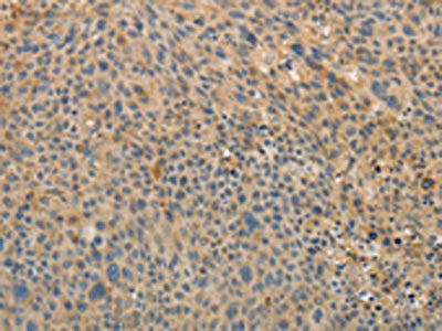 The image on the left is immunohistochemistry of paraffin-embedded Human liver cancer tissue using the antibody Antibody) at dilution 1/10, on the right is treated with fusion protein. (Original magnification: x200)Rabbit anti-Human OCLN Polyclonal Antibody