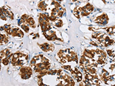 The image on the left is immunohistochemistry of paraffin-embedded Human thyroid cancer tissue using HINT2 Antibody(HINT2 Antibody) at dilution 1/50, on the right is treated with fusion protein. (Original magnification: ×200)Rabbit anti-Human HINT2 Polyclonal Antibody