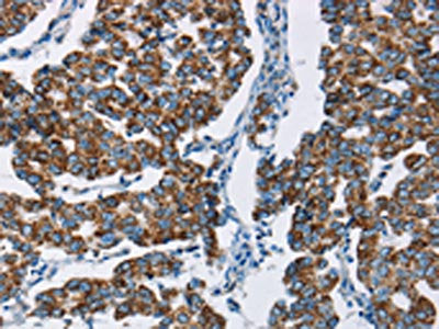 The image on the left is immunohistochemistry of paraffin-embedded Human breast cancer tissue using the antibody Antibody) at dilution 1/50, on the right is treated with fusion protein. (Original magnification: ×200)Rabbit anti-Human HINT2 Polyclonal Antibody