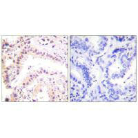 Immunohistochemical analysis of paraffin-embedded human lung carcinoma tissue using Cullin 2 antibody.Rabbit anti-Human CUL2 Polyclonal Antibody