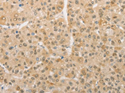 The image on the left is immunohistochemistry of paraffin-embedded Human liver cancer tissue using PGK2 Antibody(PGK2 Antibody) at dilution 1/50, on the right is treated with fusion protein. (Original magnification: ×200)Rabbit anti-Human PGK2 Polyclonal Antibody