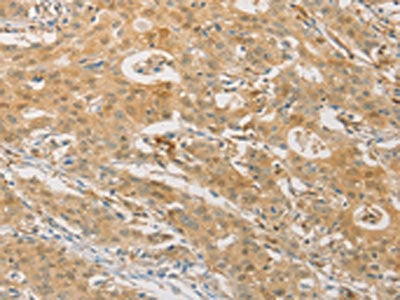 The image on the left is immunohistochemistry of paraffin-embedded Human gastic cancer tissue using the antibody Antibody) at dilution 1/50, on the right is treated with fusion protein. (Original magnification: ×200)Rabbit anti-Human PGK2 Polyclonal Antibody