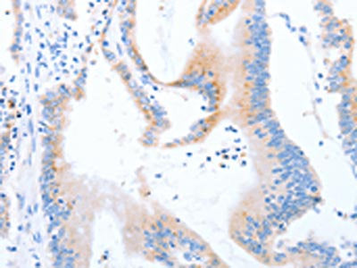 The image on the left is immunohistochemistry of paraffin-embedded Human colon cancer tissue using STK4 Antibody(STK3/STK4 Antibody) at dilution 1/70, on the right is treated with synthetic peptide. (Original magnification: ×200)Rabbit anti-Human STK4 Polyclonal Antibody