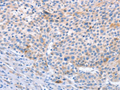 The image on the left is immunohistochemistry of paraffin-embedded Human liver cancer tissue using the antibody Antibody) at dilution 1/70, on the right is treated with synthetic peptide. (Original magnification: ×200)Rabbit anti-Human STK4 Polyclonal Antibody