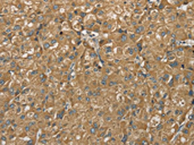 The image on the left is immunohistochemistry of paraffin-embedded Human liver cancer tissue using SDHB Antibody(SDHB Antibody) at dilution 1/30, on the right is treated with synthetic peptide. (Original magnification: ×200)
