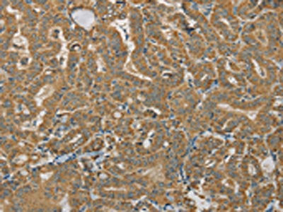 The image on the left is immunohistochemistry of paraffin-embedded Human thyroid cancer tissue using the antibody Antibody) at dilution 1/30, on the right is treated with synthetic peptide. (Original magnification: ×200)