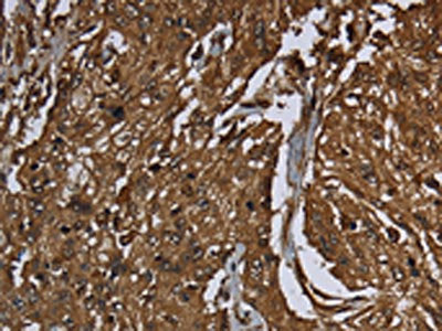 The image on the left is immunohistochemistry of paraffin-embedded Human esophagus cancer tissue using ARHGDIA Antibody(ARHGDIA Antibody) at dilution 1/50, on the right is treated with fusion protein. (Original magnification: ×200)Rabbit anti-Human ARHGDIA Polyclonal Antibody