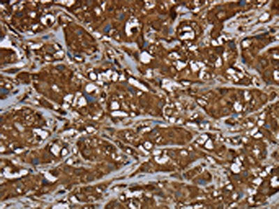 The image on the left is immunohistochemistry of paraffin-embedded Human breast cancer tissue using the antibody Antibody) at dilution 1/50, on the right is treated with fusion protein. (Original magnification: ×200)
