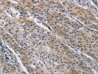 The image on the left is immunohistochemistry of paraffin-embedded Human gastric cancer tissue using BMP15 Antibody(BMP15 Antibody) at dilution 1/40, on the right is treated with fusion protein. (Original magnification: ×200)