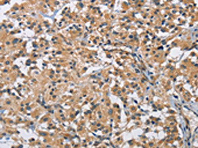 The image on the left is immunohistochemistry of paraffin-embedded Human thyroid cancer tissue using the antibody Antibody) at dilution 1/40, on the right is treated with fusion protein. (Original magnification: ×200)