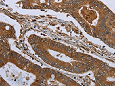 The image on the left is immunohistochemistry of paraffin-embedded Human colon cancer tissue using KLRF1 Antibody(KLRF1 Antibody) at dilution 1/30, on the right is treated with synthetic peptide. (Original magnification: ×200)
