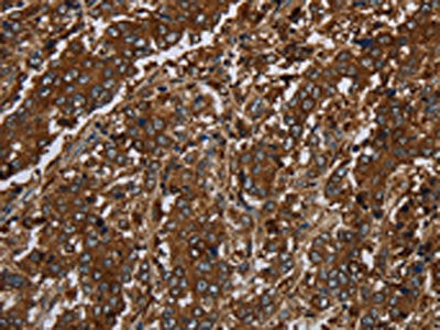 The image on the left is immunohistochemistry of paraffin-embedded Human liver cancer tissue using the antibody Antibody) at dilution 1/30, on the right is treated with synthetic peptide. (Original magnification: ×200)