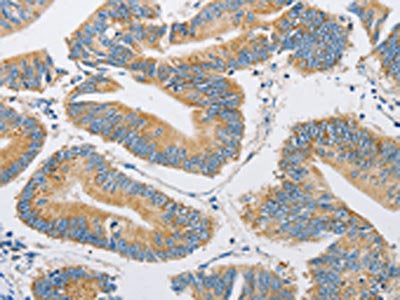 The image on the left is immunohistochemistry of paraffin-embedded Human colon cancer tissue using FARSB Antibody(FARSB Antibody) at dilution 1/20, on the right is treated with fusion protein. (Original magnification: ×200)Rabbit anti-Human FARSB Polyclonal Antibody