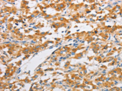 The image on the left is immunohistochemistry of paraffin-embedded Human thyroid cancer tissue using the antibody Antibody) at dilution 1/20, on the right is treated with fusion protein. (Original magnification: ×200)Rabbit anti-Human FARSB Polyclonal Antibody