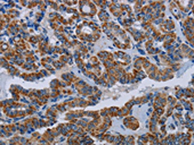 The image on the left is immunohistochemistry of paraffin-embedded Human thyroid cancer tissue using the antibody Antibody) at dilution 1/20, on the right is treated with fusion protein. (Original magnification: ×200)Rabbit anti-Human NDUFS8 Polyclonal Antibody