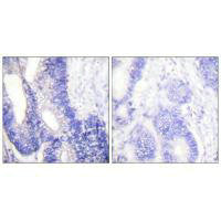 Immunohistochemical analysis of paraffin-embedded human colon carcinoma tissue using Claudin 3 antibody.Rabbit anti-Human CLDN3 Polyclonal Antibody