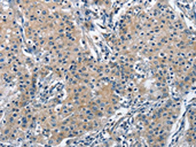 The image on the left is immunohistochemistry of paraffin-embedded Human gastric cancer tissue using TRIP4 Antibody(TRIP4 Antibody) at dilution 1/50, on the right is treated with fusion protein. (Original magnification: ×200)Rabbit anti-Human TRIP4 Polyclonal Antibody