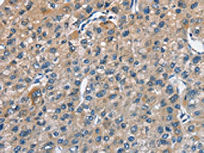 The image on the left is immunohistochemistry of paraffin-embedded Human liver cancer tissue using the antibody Antibody) at dilution 1/50, on the right is treated with fusion protein. (Original magnification: ×200)Rabbit anti-Human TRIP4 Polyclonal Antibody