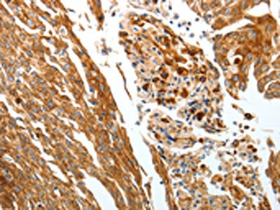 The image on the left is immunohistochemistry of paraffin-embedded Human cervical cancer tissue using SLC22A3 Antibody(SLC22A3 Antibody) at dilution 1/25, on the right is treated with synthetic peptide. (Original magnification: ×200)Rabbit anti-Human SLC22A3 Polyclonal Antibody