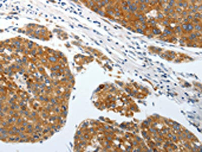 The image on the left is immunohistochemistry of paraffin-embedded Human liver cancer tissue using the antibody Antibody) at dilution 1/25, on the right is treated with synthetic peptide. (Original magnification: ×200)Rabbit anti-Human SLC22A3 Polyclonal Antibody