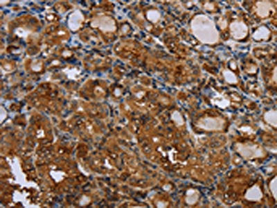 The image on the left is immunohistochemistry of paraffin-embedded Human thyroid cancer tissue using CSF2RA Antibody(CSF2RA Antibody) at dilution 1/35, on the right is treated with synthetic peptide. (Original magnification: ×200)Rabbit anti-Human CSF2RA Polyclonal Antibody