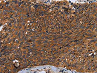 The image on the left is immunohistochemistry of paraffin-embedded Human cervical cancer tissue using the antibody Antibody) at dilution 1/35, on the right is treated with synthetic peptide. (Original magnification: ×200)Rabbit anti-Human CSF2RA Polyclonal Antibody