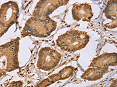 The image on the left is immunohistochemistry of paraffin-embedded Human colon cancer tissue using the antibody Antibody) at dilution 1/50, on the right is treated with synthetic peptide. (Original magnification: ×200)