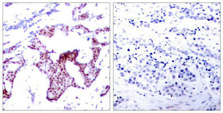 Immunohistochemical analysis of paraffin-embedded  human breast carcinoma tissue using NFκB-p65  (Phospho-Ser276) Antibody (left) or the same  antibody preincubated with blocking peptide  (right).Rabbit anti-Human RELA Polyclonal Antibody