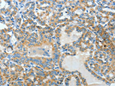 The image on the left is immunohistochemistry of paraffin-embedded Human thyroid cancer tissue using BAAT Antibody(BAAT Antibody) at dilution 1/30, on the right is treated with fusion protein. (Original magnification: ×200)