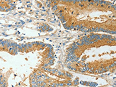 The image on the left is immunohistochemistry of paraffin-embedded Human colon cancer tissue using the antibody Antibody) at dilution 1/30, on the right is treated with fusion protein. (Original magnification: ×200)