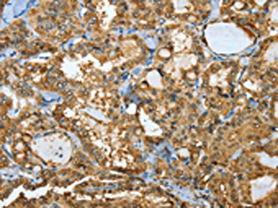 The image on the left is immunohistochemistry of paraffin-embedded Human thyroid cancer tissue using ANXA3 Antibody(ANXA3 Antibody) at dilution 1/35, on the right is treated with fusion protein. (Original magnification: ×200)Rabbit anti-Human ANXA3 Polyclonal Antibody