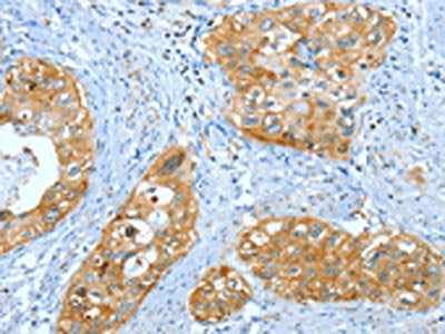 The image on the left is immunohistochemistry of paraffin-embedded Human cervical cancer tissue using the antibody Antibody) at dilution 1/35, on the right is treated with fusion protein. (Original magnification: ×200)Rabbit anti-Human ANXA3 Polyclonal Antibody