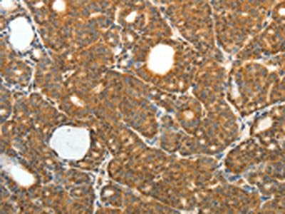 The image on the left is immunohistochemistry of paraffin-embedded Human thyroid cancer tissue using PRDX3 Antibody(PRDX3 Antibody) at dilution 1/50, on the right is treated with fusion protein. (Original magnification: ×200)Rabbit anti-Human PRDX3 Polyclonal Antibody