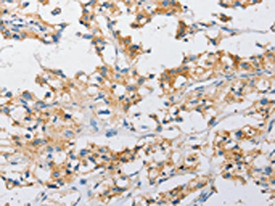 The image on the left is immunohistochemistry of paraffin-embedded Human thyroid cancer tissue using ATG4C Antibody(ATG4C Antibody) at dilution 1/25, on the right is treated with fusion protein. (Original magnification: ×200)