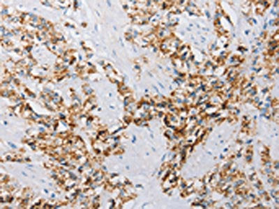 The image on the left is immunohistochemistry of paraffin-embedded Human prostate cancer tissue using the antibody Antibody) at dilution 1/25, on the right is treated with fusion protein. (Original magnification: ×200)