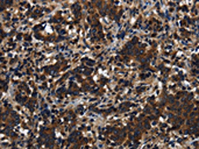 The image on the left is immunohistochemistry of paraffin-embedded Human liver cancer tissue using KLHL8 Antibody(KLHL8 Antibody) at dilution 1/20, on the right is treated with synthetic peptide. (Original magnification: ×200)