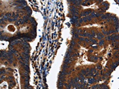 The image on the left is immunohistochemistry of paraffin-embedded Human colon cancer tissue using the antibody Antibody) at dilution 1/20, on the right is treated with synthetic peptide. (Original magnification: ×200)