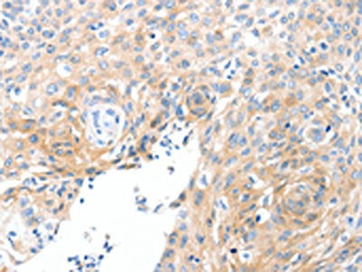 The image on the left is immunohistochemistry of paraffin-embedded Human cervical cancer tissue using SLC22A17 Antibody(SLC22A17 Antibody) at dilution 1/30, on the right is treated with synthetic peptide. (Original magnification: ×200)Rabbit anti-Human SLC22A17 Polyclonal Antibody