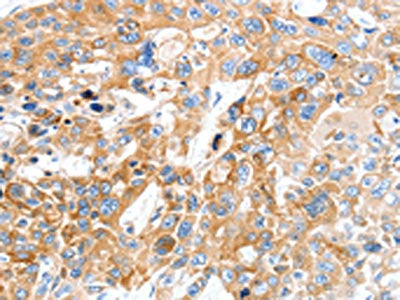 The image on the left is immunohistochemistry of paraffin-embedded Human esophagus cancer tissue using the antibody Antibody) at dilution 1/30, on the right is treated with synthetic peptide. (Original magnification: ×200)Rabbit anti-Human SLC22A17 Polyclonal Antibody