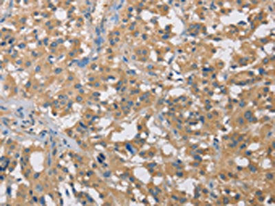 The image on the left is immunohistochemistry of paraffin-embedded Human thyroid cancer tissue using CST2 Antibody(CST2 Antibody) at dilution 1/50, on the right is treated with fusion protein. (Original magnification: ×200)Rabbit anti-Human CST2 Polyclonal Antibody