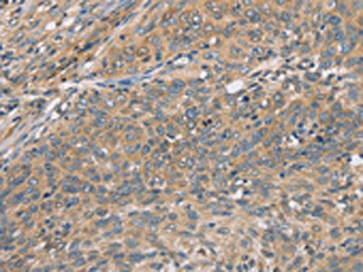 The image on the left is immunohistochemistry of paraffin-embedded Human cervical cancer tissue using the antibody Antibody) at dilution 1/50, on the right is treated with fusion protein. (Original magnification: ×200)Rabbit anti-Human CST2 Polyclonal Antibody