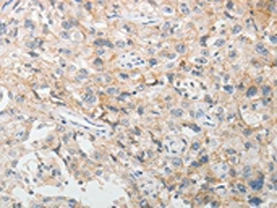 The image on the left is immunohistochemistry of paraffin-embedded Human esophagus cancer tissue using CDH3 Antibody(CDH3 Antibody) at dilution 1/5, on the right is treated with fusion protein. (Original magnification: ×200)Rabbit anti-Human CDH3 Polyclonal Antibody