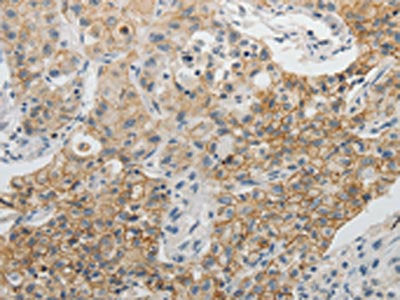 The image on the left is immunohistochemistry of paraffin-embedded Human lung cancer tissue using the antibody Antibody) at dilution 1/5, on the right is treated with fusion protein. (Original magnification: ×200)Rabbit anti-Human CDH3 Polyclonal Antibody