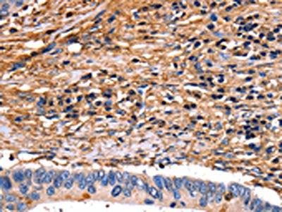 The image on the left is immunohistochemistry of paraffin-embedded Human colon cancer tissue using ANXA6 Antibody(ANXA6 Antibody) at dilution 1/17, on the right is treated with fusion protein. (Original magnification: ×200)Rabbit anti-Human ANXA6 Polyclonal Antibody