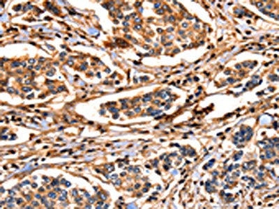 The image on the left is immunohistochemistry of paraffin-embedded Human breast cancer tissue using the antibody Antibody) at dilution 1/17, on the right is treated with fusion protein. (Original magnification: ×200)Rabbit anti-Human ANXA6 Polyclonal Antibody
