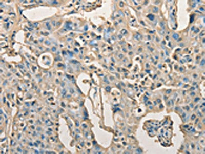 The image on the left is immunohistochemistry of paraffin-embedded Human lung cancer tissue using AGBL2 Antibody(AGBL2 Antibody) at dilution 1/25, on the right is treated with fusion protein. (Original magnification: ×200)Rabbit anti-Human AGBL2 Polyclonal Antibody