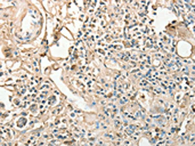 The image on the left is immunohistochemistry of paraffin-embedded Human gastric cancer tissue using the antibody Antibody) at dilution 1/25, on the right is treated with fusion protein. (Original magnification: ×200)