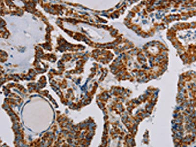 The image on the left is immunohistochemistry of paraffin-embedded Human thyroid cancer tissue using NDUFS3 Antibody(NDUFS3 Antibody) at dilution 1/30, on the right is treated with fusion protein. (Original magnification: ×200)Rabbit anti-Human NDUFS3 Polyclonal Antibody