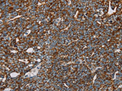 The image on the left is immunohistochemistry of paraffin-embedded Human cervical cancer tissue using the antibody Antibody) at dilution 1/30, on the right is treated with fusion protein. (Original magnification: ×200)Rabbit anti-Human NDUFS3 Polyclonal Antibody